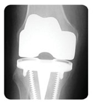 What's involved in a total knee replacement