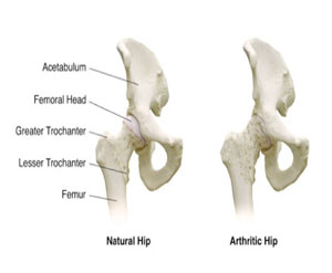 Hip Condition