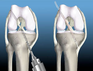 Knee Conditions