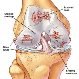 Disease of the knee